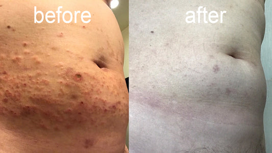 Eczema and atopic dermatitis that even renowned doctors cannot effectively treat.