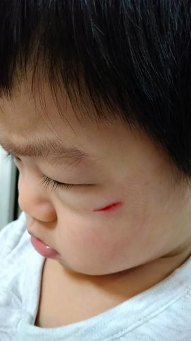 Thank you, Erica, for saving my child's face from scar